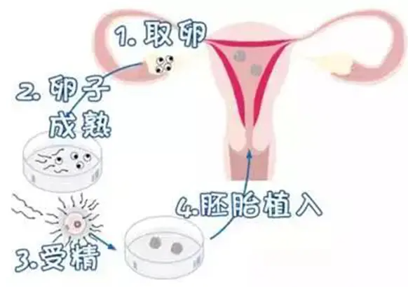 试管婴儿取卵的注意事项! 取卵后腹胀和腹痛的原因